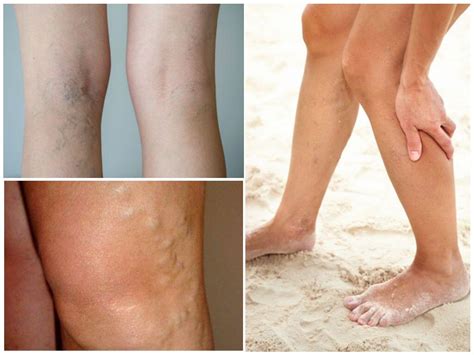 tratamentul ulcerelor trofice pe picior cu vene varicoase remedii populare